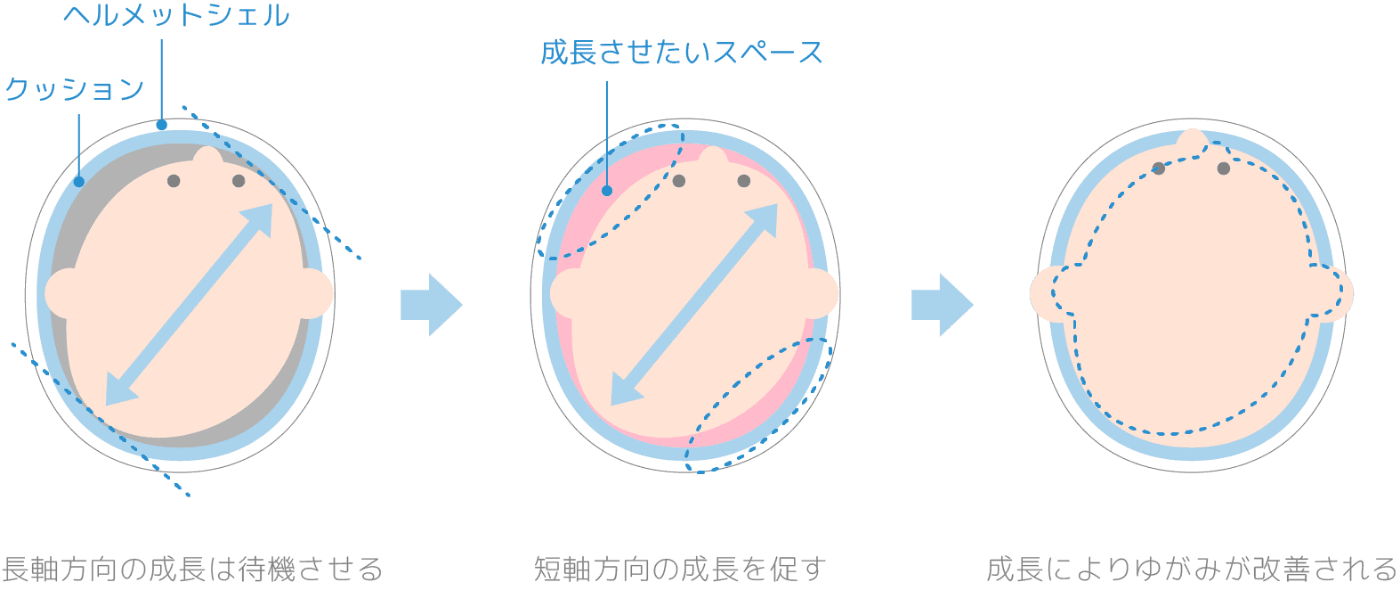 ヘルメット治療のしくみ